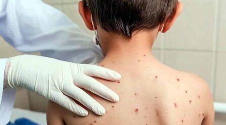 Casos de sarampión se mantienen bajo vigilancia epidemiológica en México: SSA