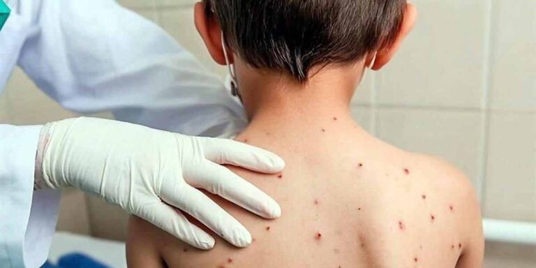 Casos de sarampión se mantienen bajo vigilancia epidemiológica en México: SSA